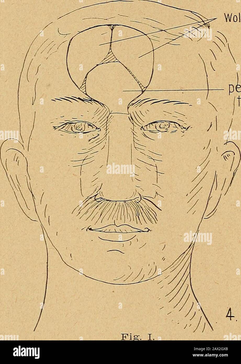 Present Status Of Plastic Surgery About The Ear Face And Neck Defect 4v I5ted Pedicle Foreheadflap Overnose Fig I 8 Beck Present Status Oe Plastic Surgery Other When The Defect Was Confined To