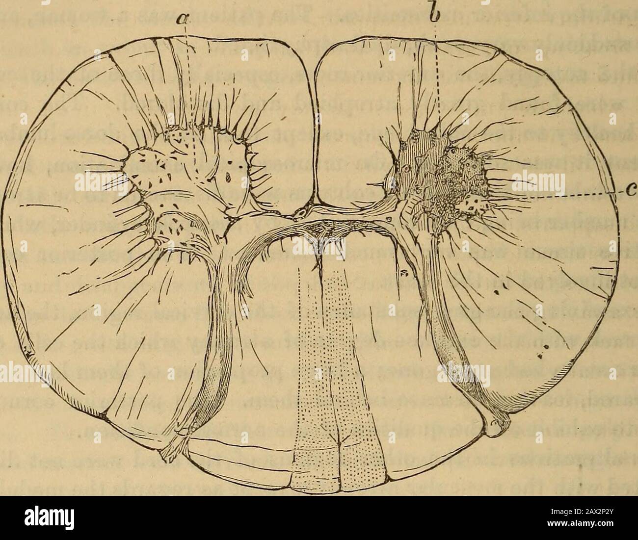 Spinal cord lesions hires stock photography and images Alamy