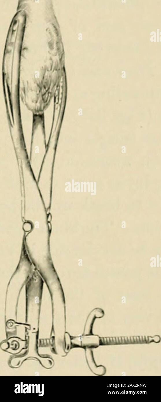 The American text-book of obstetrics for practitioners and students . &gt; Fig. 245.—Tarniers basiotribe Fig. 2-lfi.—The first blade f Fig. 247.- The Becond blade Inaction; the perforator being in tlu&gt; basiotribe has crushed the of the baslotribe has crashed the place, as 1b also the first blade. occiput, and the Becond blade sinciput. is applied. grasp the head so securely, and is more likely to slip than the cranioclast. The cephalotribe is therefore less useful in ordinary cases, and is nowaday-very little used. The Hicks model (Fii*. 24:2) is preferred in England, whileLusks instrument Stock Photo