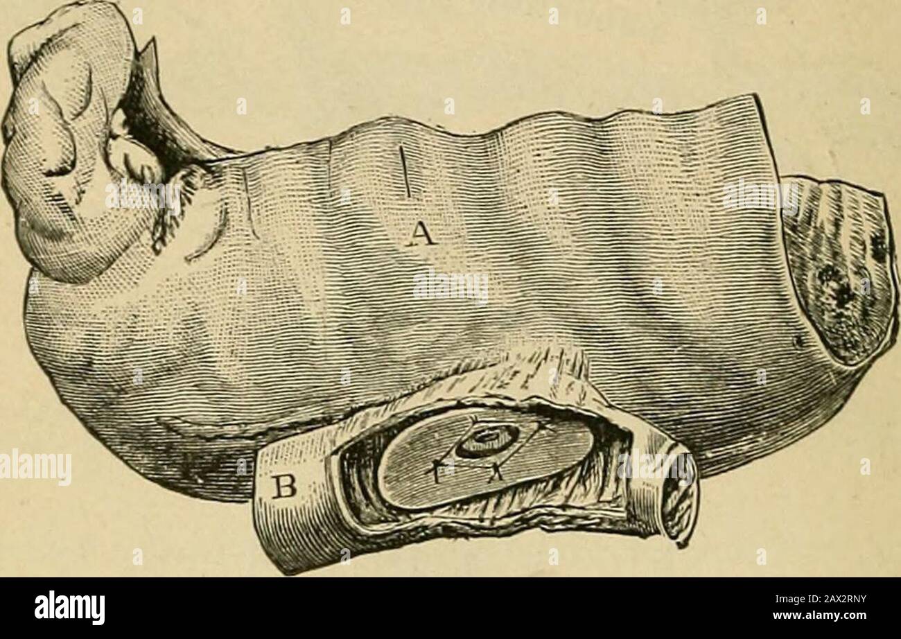 Surgery; its theory and practice . Dilatation of the stomach from carcinomatous stricture of the pylorus. The stomach held tenpints. (St. Bartholomews Hospital Museum, No. 1923^.) the other in the termination of the duodenum or commencementof the jejunum, in the way shown in Fig. 292. A reaction,26* 6i8 DISEASES OF REGIONS. however, seems setting in against the use of Senns plates, since itis thought by some that they favor regurgitation of the contents ofthe intestine into the stomach, and that after their use there is atendency for the aperture between the viscera to contract. ByPostnikow th Stock Photo