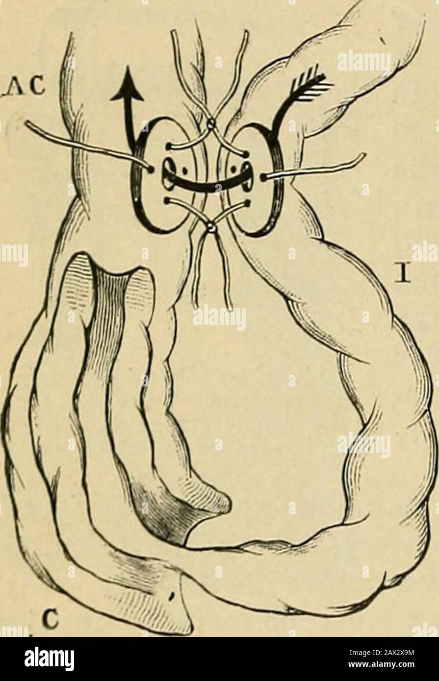 Surgery; its theory and practice . action just below theapex of the intussusceptum; orbetter, try to squeeze out the in-tussusceptum by kneading andpressure from below. Reductionmay possibly be aided by insuffla-tion of the rectum with air or hy-drogen. If adhesions have formed,try to break them down by gentlyinsinuating a probe between thecontiguous serous surfaces. Afterreduction search for any rent in theperitoneal coat and bring it together by suture and seal with anomentum graft. Reduction failirg, the following courses areopen: i. Exclusion of the intussusception by leaving it in situand Stock Photo