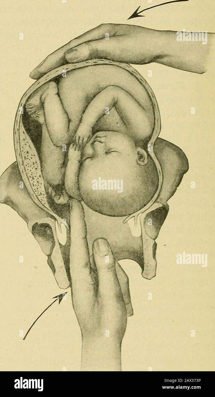 The practice of obstetrics, designed for the use of students and practitioners of medicine . Fig. 1119.—-Combined or Bipolar Po-dalic Version. Braxton HickssMethod. First Step. Fig. 1120.—Combined or Bipolar Podalic Ver-sion. Braxton Hickss Method. SecondStep. a practical necessity. The dorsal posture of the patient upon a sufficientlyhigh table is usually to be preferred, although the lateral or exaggerated semi-prone can be substituted in difficult cases. (See page 872.) The internal handshould be the one whose fingers naturally flex toward the fetal head; thus, in leftscapula positions the Stock Photo