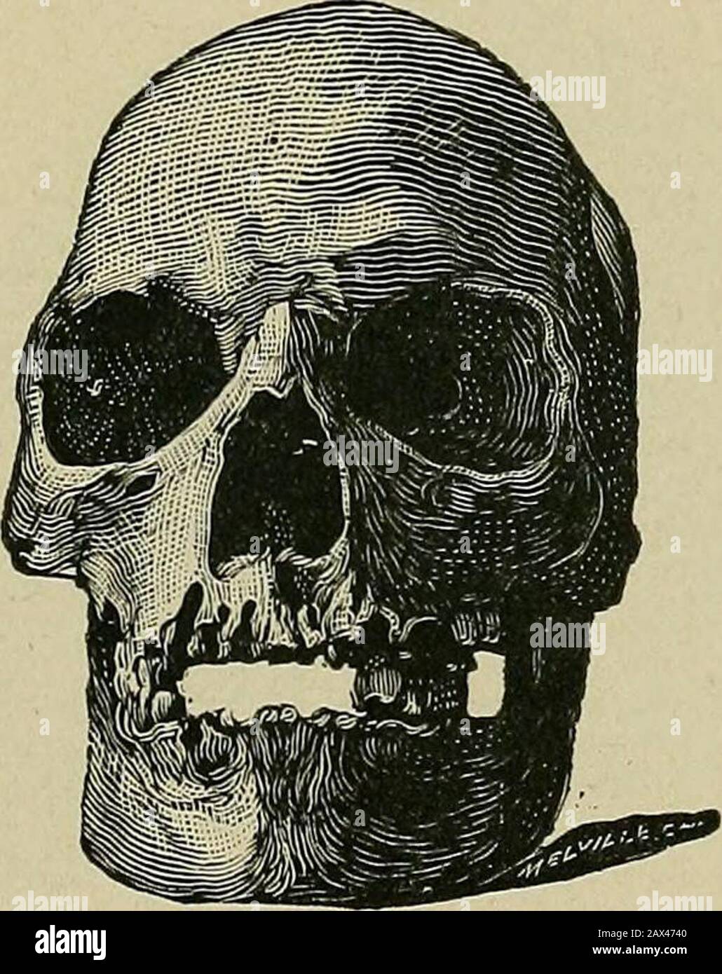 The etiology of osseous deformities of the head, face, jaws and teeth . types are seen in the importedcriminal. This is instructive as explanatory of some of theapparently dogmatic claims of European criminal anthropol-ogists. We have found that left-handedness is not so com-mon among American and foreign-American criminals as hasbeen claimed by these authorities. Among 400 criminals in THE HEAD, FACE, JAWS AND TEETH 137 the Joliet penitentiary but one per cent were found to beleft-handed. Dr. Lydston found but about two per centamong the criminals in the New York City prison. Obviouslya much Stock Photo