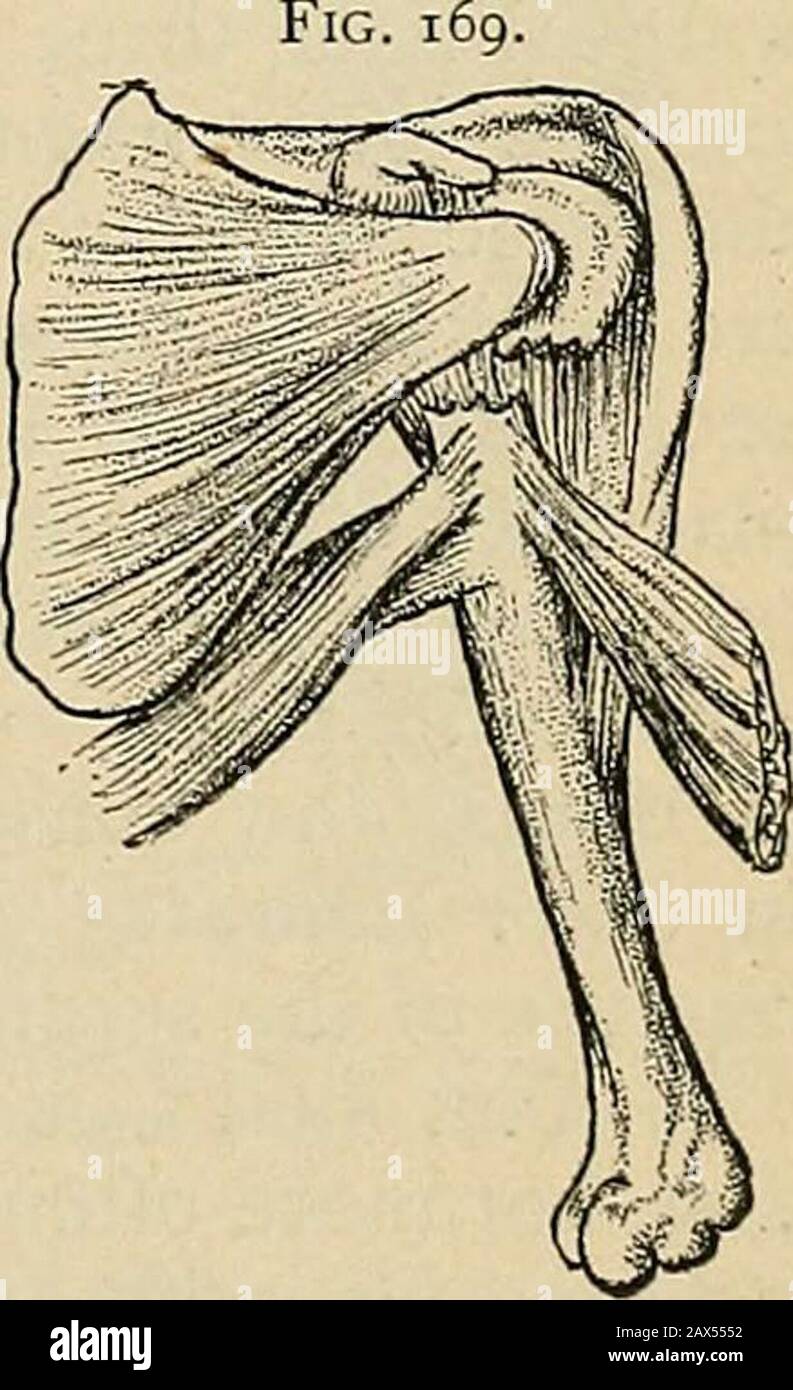 Surgery; its theory and practice . ut theshoulder. It may, like the intracapsularvariety, be impacted or non-impacted ; butwhen impaction occurs it is the lower frag-ment that is driven into the upper, /. &lt;?.,the narrower shaft between the broadertuberosities. Cause. — Generally direct.violence. Natuj-e of the displacement.—The upper fragment is rotated outwards bythe three muscles inserted into the greatertuberosity; the lower fragment is drawnupwards by the deltoid and inwards by thethree muscles inserted into the bicipitalridges (Fig. 169). Signs.—Pain, swellingand impaired movement; mar Stock Photo