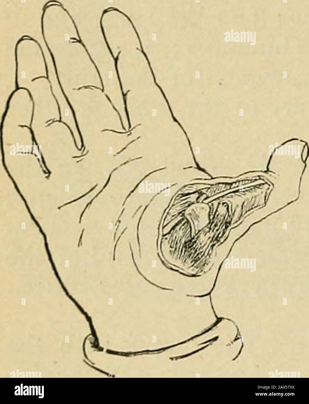 Surgery; its theory and practice . the flexorbrevis and intervening between themetacarpal bone and the phalanx,prevent the articular surfaces of thebones being brought into contact. Treatment.—Press the meta-carpal bone well into the palm of the hand to relax the flexorbrevis polhcis, and bend back the first phalanx on the metacarpalbone until the extremity of the thumb points towards the wrist,thus forcing the base of the phalanx wedge-wise between the twoinsertions of the short flexor. Next flex the phalanx while an as-sistant, by placing his thumb behind its base, prevents its slippingback. Stock Photo