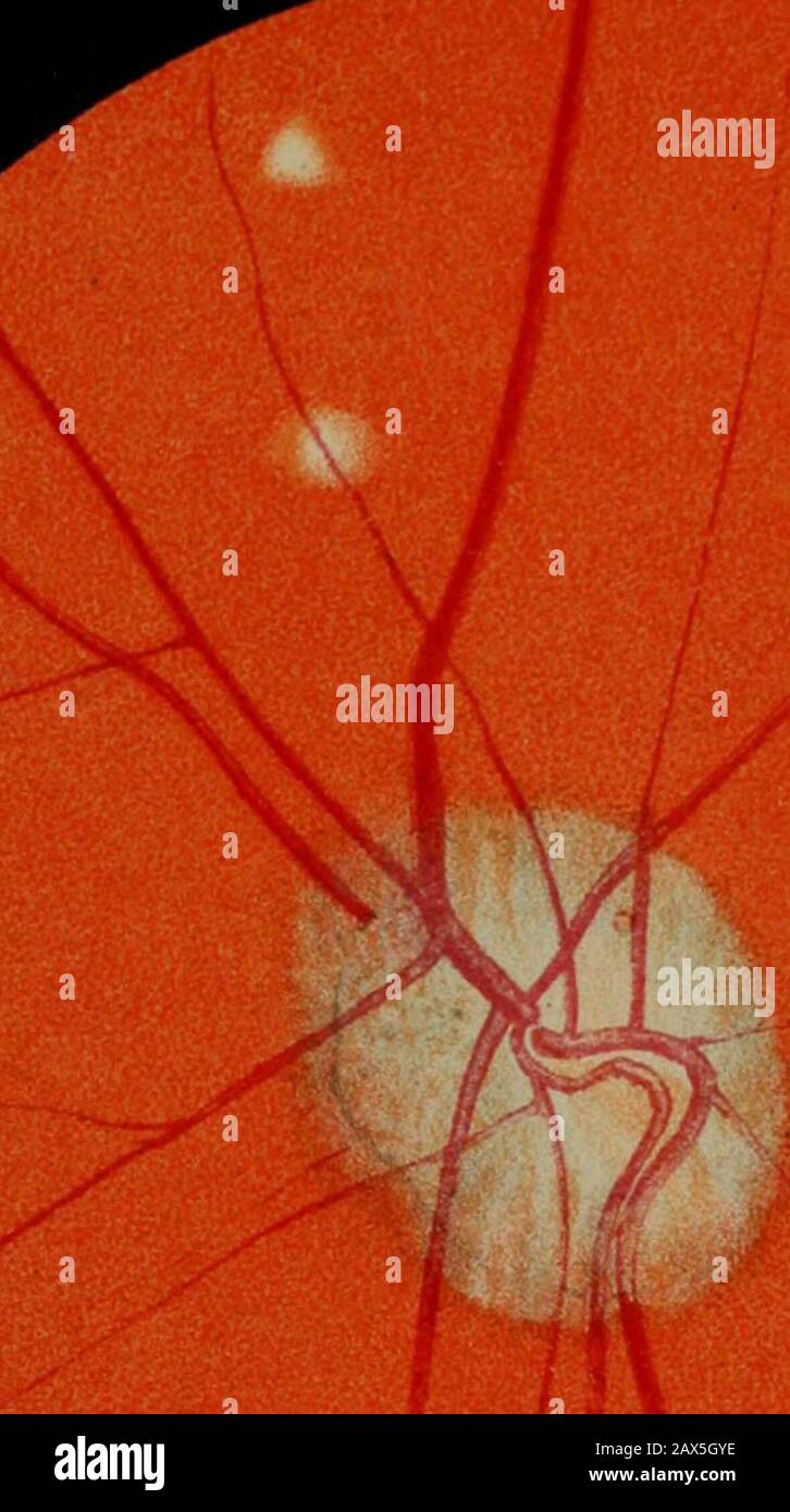 Transactions . ination was carried out by Dr. Maguirein the Pathological Laboratory of Owens College, and,although exceptional care was taken, no rods could befound. I confess I was not disappointed, because in acase of tuberculosis confined to the eyeball, which I hadthe honour of bringing before the Society, every knownstaining was tried without avail to detect bacilli. Whetherthey exist as a spore which will not stain, or whether, * A full report of the case will be found in the Medical Times for ISS-i,vol. ii, p. 80.t p. 198. DESCRIPTION OE PLATE YII. Eig. 1 shows the ophthalmoscopic appea Stock Photo