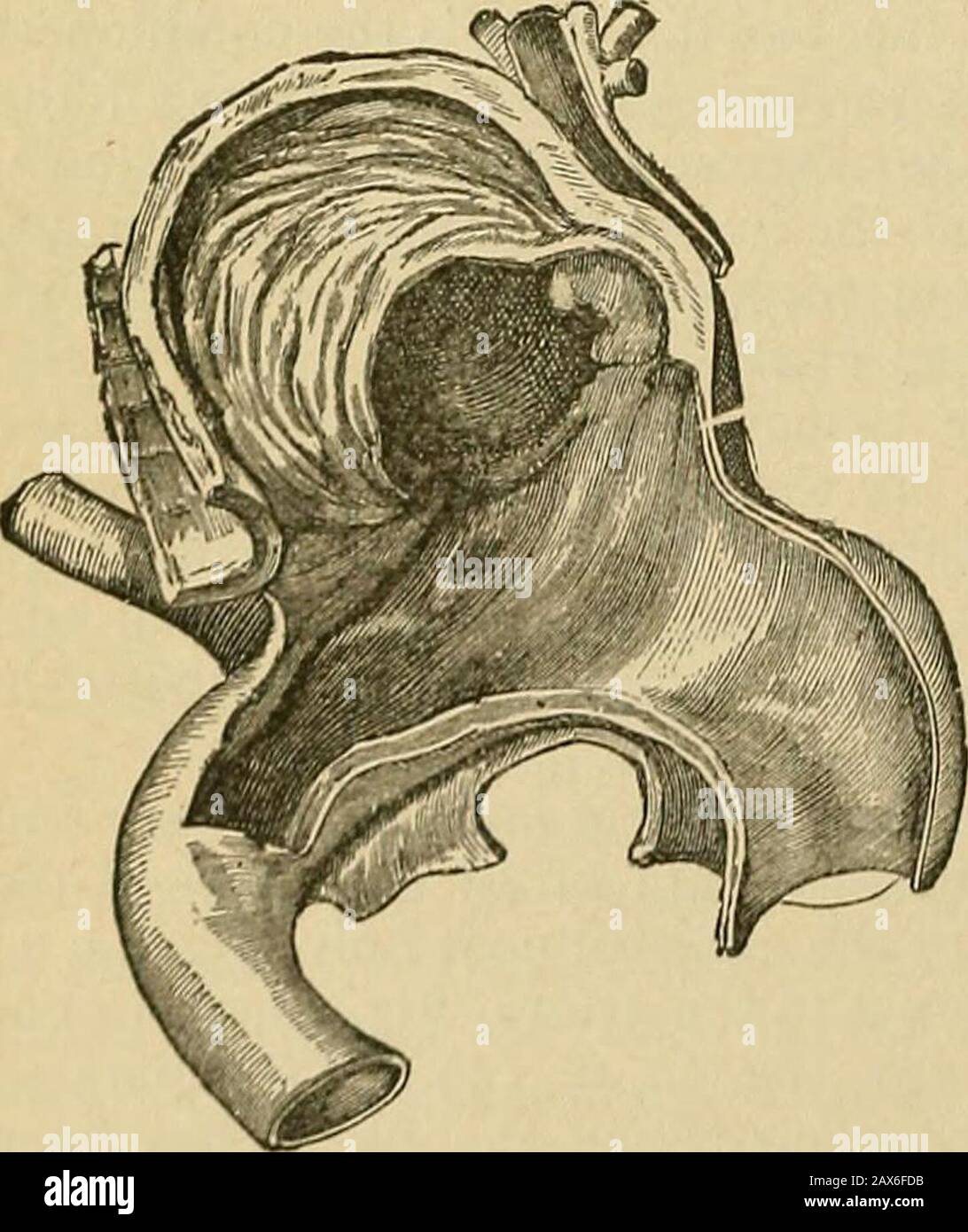 Surgery; its theory and practice . in concentric layers upon the internal  surface of the sac, so thatafter it has existed some time the contents are  partly solid lami-nated fibrin, and partly