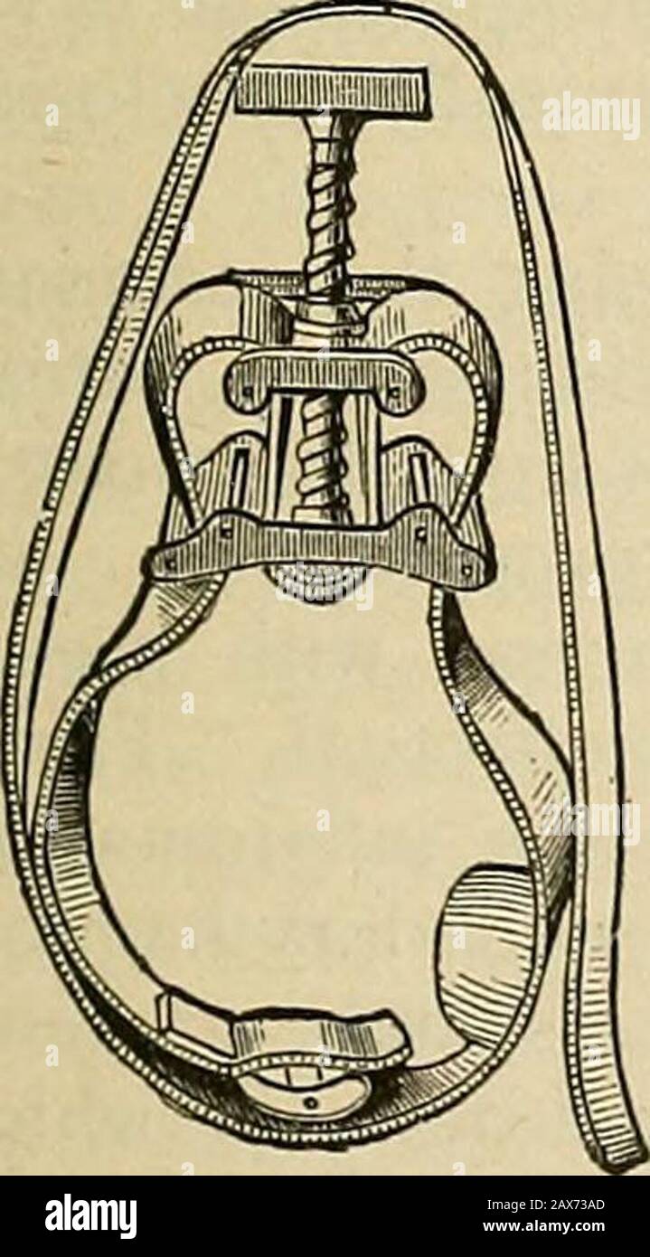 Surgery; its theory and practice . Spencer Wells pressure-forceps, modified by Morrant Baker. the latter situation with the finger or the tourniquet, the pressurebeing then made in such a direction as to press the artery againstsome resisting structure, as a point of bone. The tourniquetsemployed are various (Fig. 31 and Fig. 32). The rubber tubeof the Esmarchs apparatus perhaps answers the best. An im-promptu tourniquet may be made by tying a pocket-handkerchiefloosely round the limb, and twisting it up tightly with a walking- FlG. 31. Fig. 32.. Stock Photo