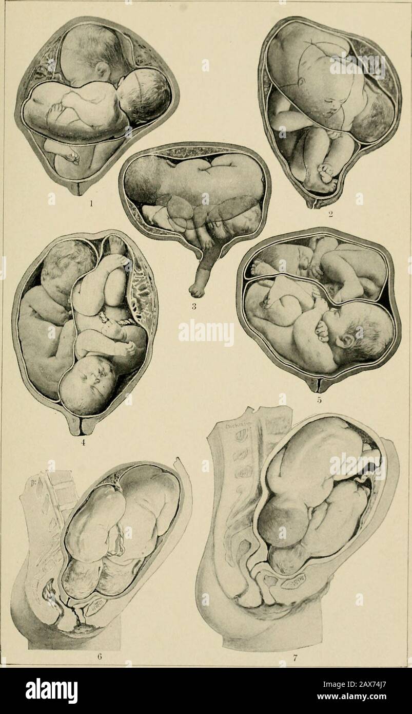 The American text-book of obstetrics for practitioners and students . Fig. 88.—Twins, head and breech (modified fromHunter). DYST0C1 . Plati. ic.. 1,2. Twins,transverse and breech. 3. rums, both transverse, i. ruins, bead and breech. 6, Twins.both transverse. 6, . Twins, both heads presenting. DYSTOCIA. .7 as distinctly pathological. Albuminuria in the mother i- the rule in multiplepregnancies, and eclampsia ie ten times more frequeni than in single birtheThere is a disposition to inertia uteri during and after birth from distentionof the &lt;-avity, and consequently a likelihood of post-part Stock Photo