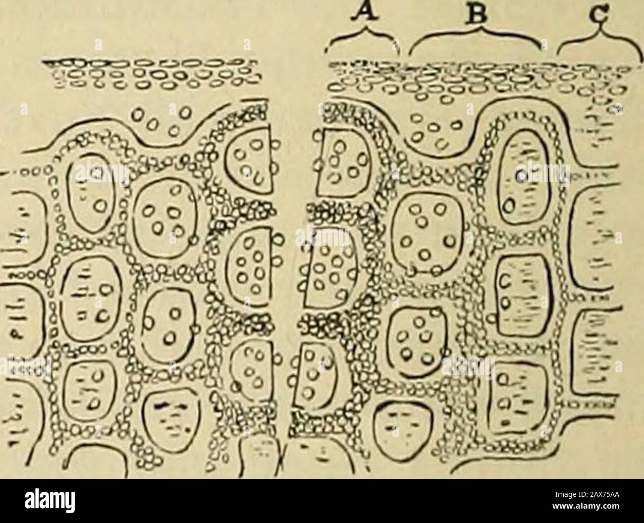 Surgery; its theory and practice . ?la* Wir?- mr^ Diagram representing a simpleincifed wound, immediately af-ter the incision has been made.. Diagram representing an incised wounda few hours after the incision. A.Area of thrombosis—leucocytes mak-ing their way to tlie cut surface. B.Area of dilated capillaries—leticocytesescaping from the vessels into the tis-sues. C. Normal tissues. in the layer of tissue bounding the incision (Fig. 22 and Fig. 23).As a consec|uence, stasis and coagulation of the blood is inducedin the divided smaller vessels and capillaries, and thus the hemor-rhage from the Stock Photo