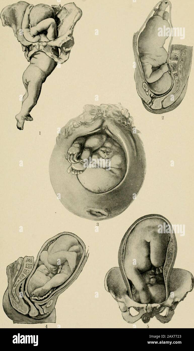 The American text-book of obstetrics for practitioners and students . and if the formeris engaged, it is usually best to apply forceps and to disregard the prolapsedextremities. In the case of nuchal position of the arm an effort should bemade to dislodge the latter, but it may be necessary to fracture it before thedelivery of the child can be secured. Multiple Births.—Twin labors are usually easy and uncomplicated (75 percent.), but complications are more frequent than in single labors. Malpresen-tations are common (PI. 40). The following table from Spiegelberg, based on1138 labors, gives the Stock Photo