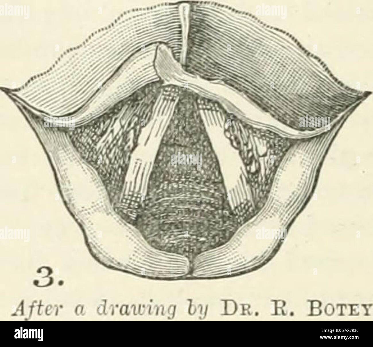 The Journal of laryngology and otology . AjUx a di-oKiiig ijy De. R. Botey.. 7 I)/ Ur. easily, with very little traction. In spite of this I believed that in the endI should have to eliminate the laryngeal condylomata, for I did not thinkthey would disappear by this treatment alone, and I feared that ultimately,perhaps, the cicatricial retraction would lead to fibrous stenosis of theglottis, and I imagined would require Schroetters tubes later on. Butnothing of this kind occurred. Little by little the laryngeal vegetationsdisappeared, the epiglottic ulceration cicatrized completely. Respiratio Stock Photo