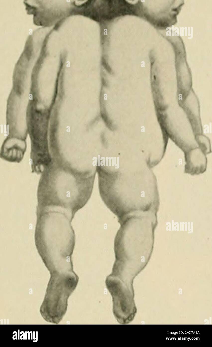 The American text-book of obstetrics for practitioners and students . Pig. 76.—Prosopothoracopagus. Pig. 77.—Xiphopagu intimately joined front to front (PL 37), spontaneous labor is possible bythe mechanism shown in Figures 82 and 83. On the other hand, the great- h YSTOCIA, 91 est difficulty may be encountered In tabor, and the most serious operation maybe demanded to deliver i he woman. ^ggmr- &gt;^*. „ Fetal tumore obstructing delivery may be hydrencephaloceles, lymphangiomata, myxo- f ^ mata, sacral teratomata. (Jystic tumore — 11 &lt;»111&lt; I be punctured. Solid tumor* may call for ver Stock Photo