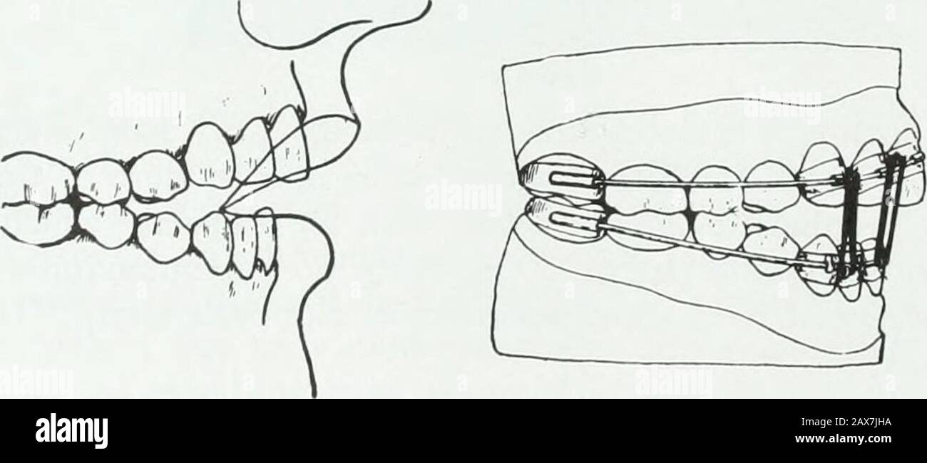 A practical treatise on the technics and principles of dental orthopedia and prosthetic correction of cleft palate . partial or complete stenosisof the nasal air passages, resulting in mouth-breathing; open-bite malocclusion;inhibited development of the maxillae; upper retrusions; and prognathic mandibles.All of these conditions at times occur in one case. The direct cause of the open-bite is through the mechanical forces of the muscles acting upon the early develop-ing mandible in mouth-breathing, mostly during the long sleeping hours. Thischaracter of open-bite is so intimately associated wi Stock Photo