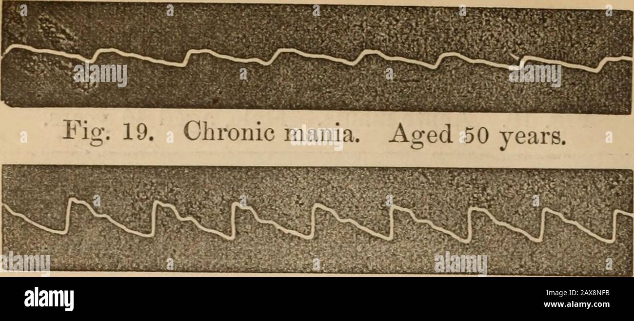 American journal of insanity . Fig. 18. Chronic mania. Aged 78 years ...