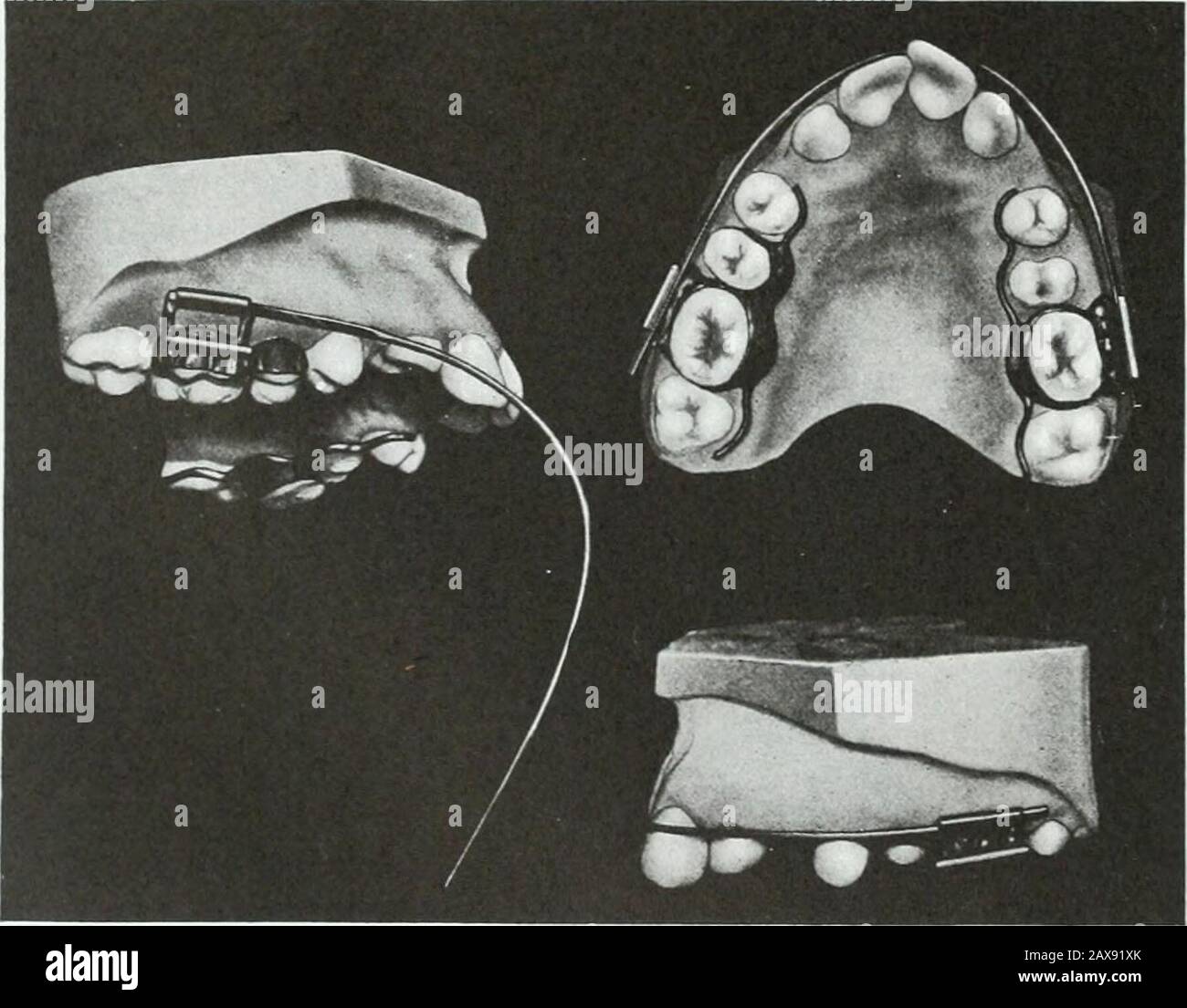 A practical treatise on the technics and principles of dental orthopedia and prosthetic correction of cleft palate . of resistance or weight, shown by the arrows. The bodily disto-mesial movement of buccal teeth to close spaces after extrac-tion so as to leave no inverted V-shaped interproximate space to pocket food is ofthe greatest importance. This is accomplished by ingenious devices for applyingthe power upon lingual and buccal root-wise extensions aided by an occlusal screw 116 PART IV. TECH NIC PRINCIPLES OF PRACTICE bar fulcrum resistance, or by long-bearing telescoping tubes at the occ Stock Photo