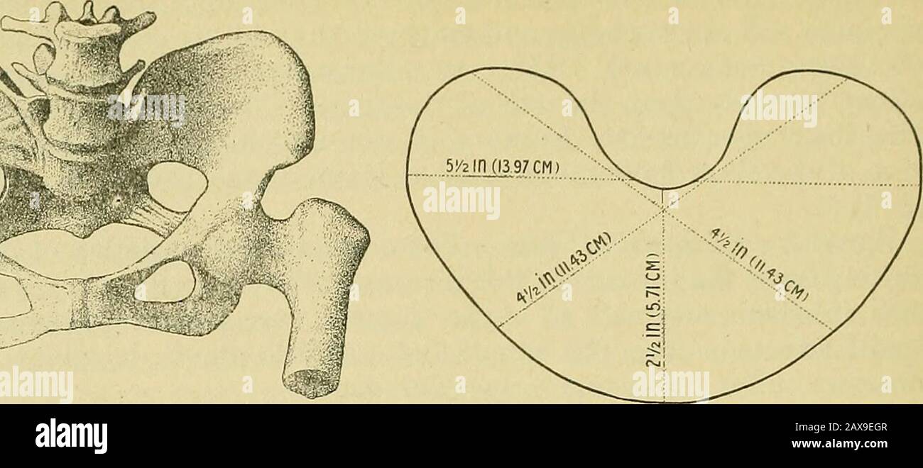 The practice of obstetrics, designed for the use of students and practitioners of medicine . Fig. 835.—Rachitic Dwarf. De-livered by C.-ESAREAN Section.—(Authors case.) 632 PATHOLOGICAL LABOR. r^^:. Fig. 836.—Rachitic Pelvis. Diminution ofall diameters, especially of the antero-pos-terior. Fig. 837.—Pelvic Inlet of Fig. 836. Stock Photo