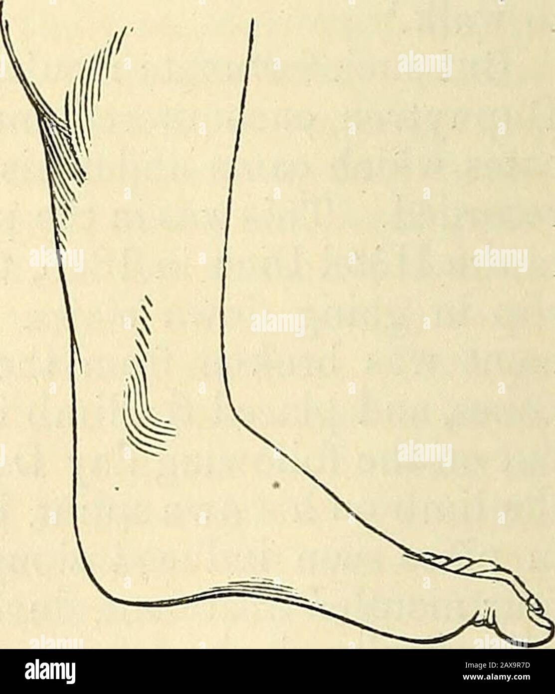 A practical treatise on fractures and dislocations . Dislocations of the lower end of the tibia backwards. Reduction should be attempted by a method similar to that whichhas been recommended in all the other dislocations of the ankle; onlywith such modifications as the peculiarities of the case must neces-sarily suggest. UPPER END OF THE FIBULA FORWARDS. 725 CHAPTER XX. DISLOCATIONS OP THE UPPER END OF THE FIBULA. Syn.—Luxations of the superior peroneo-tibial articulation; Malgaigne. Surgeons have frequently described a condition of the peroneo-tibial articulation in which the ligaments have b Stock Photo