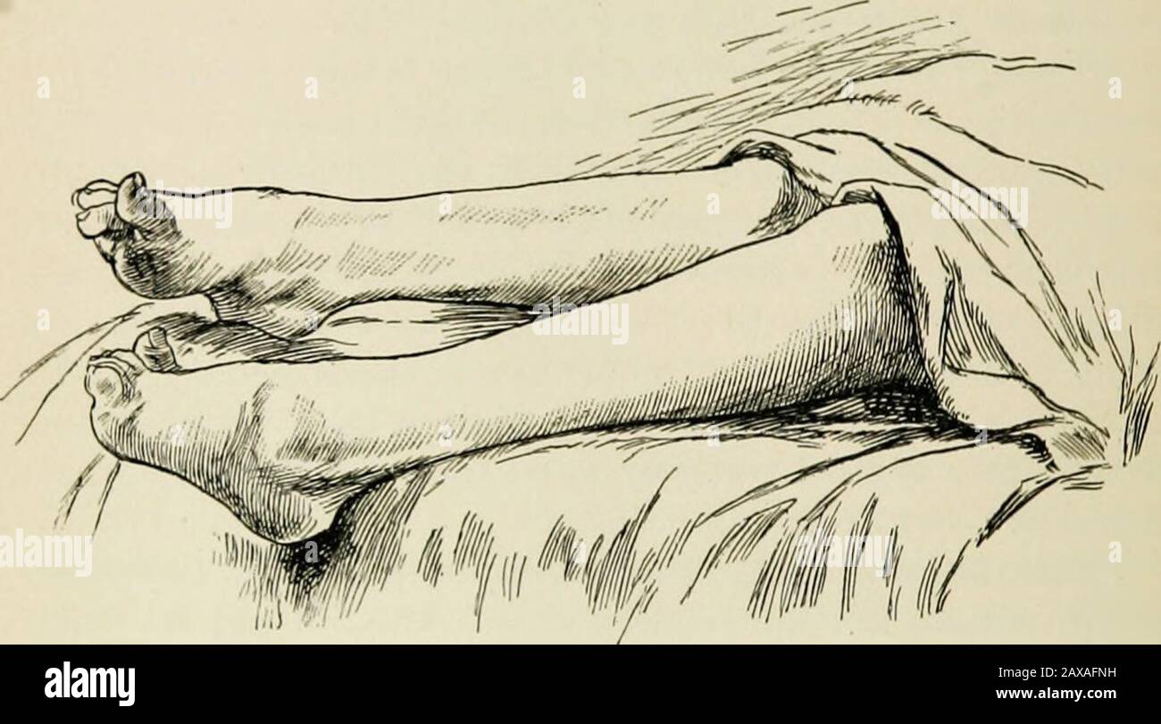 A treatise on the nervous diseases of children, for physicians and students . laterally ; the foot is in thecondition of a pes cavus. The toes are hyperextended andhave a claw shape. This deformity of the toes is said tohave been observed as one of the early symptoms by parentsin whose families this special disease has been hereditary. * Some of these may belong to the Heredo-ataxie cerebelleuse of Marie. 38: THE NERVOUS DISEASES OF CHILDREN. Muscular atrophy constitutes an important symptom ofthis disease. It is most distinctly visible in the shoulderand pelvic girdles. It was so prominent a Stock Photo