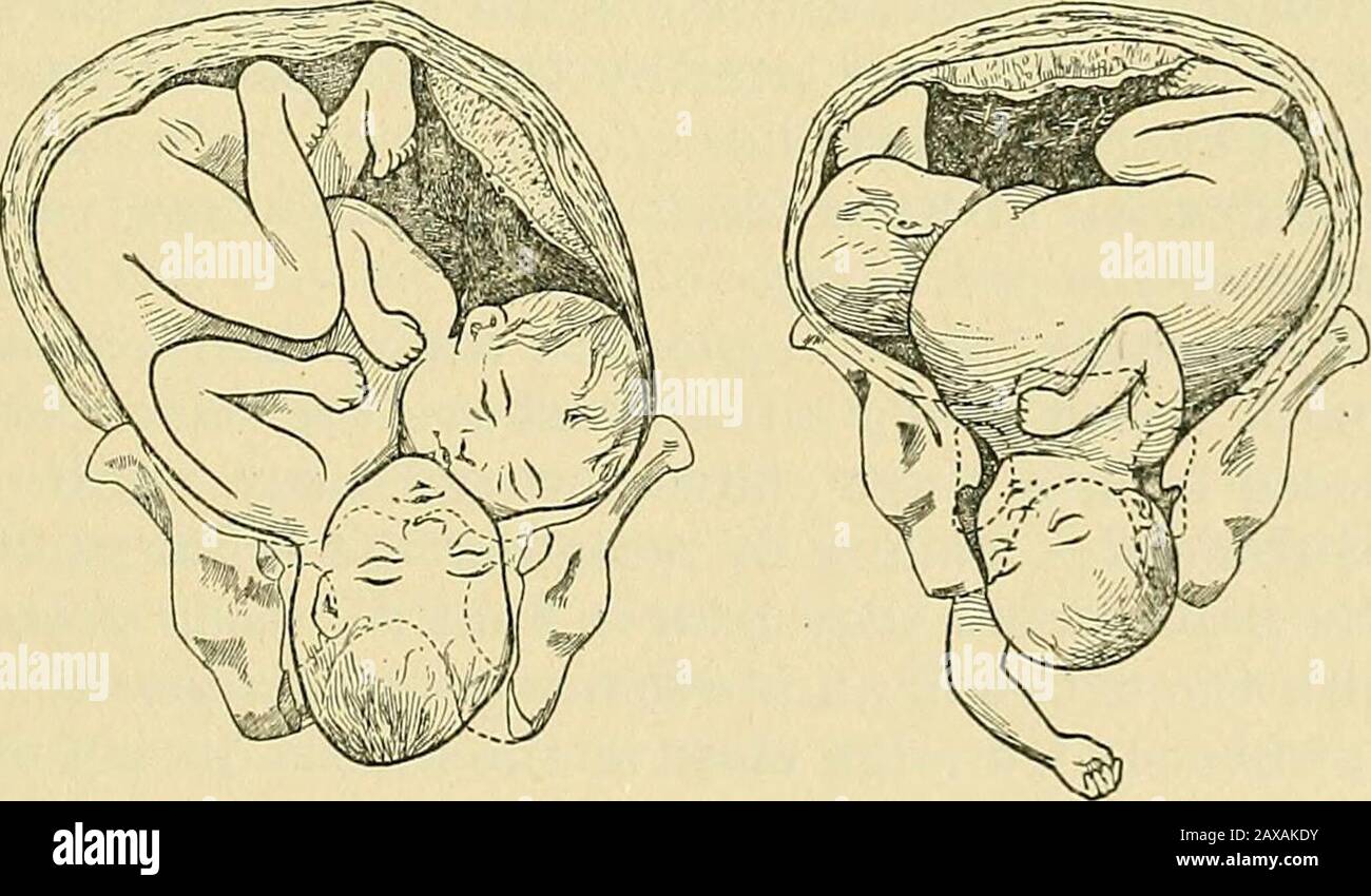 The practice of obstetrics, designed for the use of students and practitioners of medicine . Fig. 765. Fig. 766. Fig. 767.. Fig. 768. Fig. 769. Figs. 765 to 769.—Fetal Deformities Producing Dystocia. Fig. 765, Congenitalhydrocephalus. Fig. 766, Anencephalus, Fig. 767, Distention of bladder and ureters.Fig. 768, Dicephalus dibrachius. Fig. 769, Thoracopagus. mutilating and difficult extraction is required, it is better to at once performCaesarean section. (4) Should the Csesarean section be undertaken after pro-longed attempts at delivery, and sepsis is suspected, either an incomplete orcomplet Stock Photo