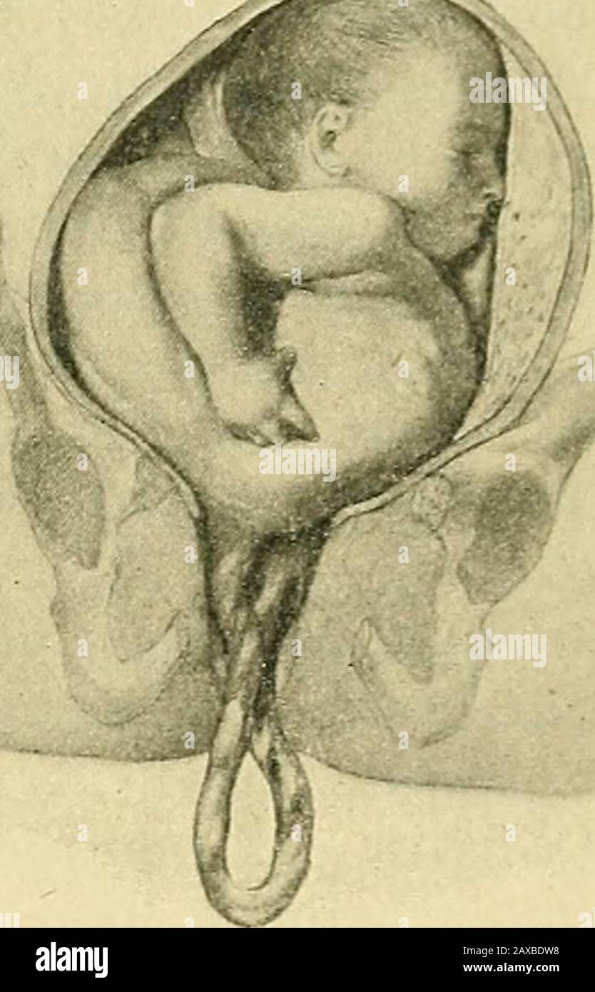 The practice of obstetrics, designed for the use of students and practitioners of medicine . osture during the firstas well as the second stage. 2. Curative Treatment.—If the child is dead, the presentation or prolapseof the cord does not, of course, constitute a special indication, for the interestsof the mother do not require that the fetus shall be extracted at once. In the curative treatment of presentation of the funis before dilatation of thecervix has taken place, or rupture of the membranes, active interference is not in-dicated. Every effort should be made to prevent the premature rup Stock Photo