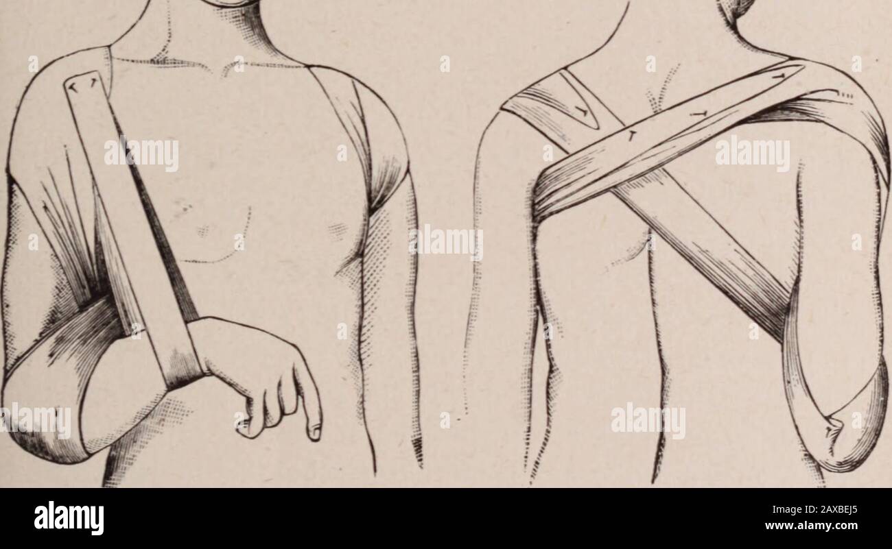Buffalo medical and surgical journal . at the elbow is kept in place by folding the upper part that fitsthe arm, and securing it by a pin. This makes a sort of cup forthe elbow. The bandage is worn with ease, except on the sound shoulder,which is vexed by the pressure of the ordinary figure eight (8). 1. These figures illustrate the application of the dressing, without descriptive titles. 368 TREATMENT OF THE CLAVICLE. It-will be observed that the shawl, as it passes in front of thearm, does not press on the axillary border of the pectoral muscle,and, therefore, avoids the objection of the ord Stock Photo