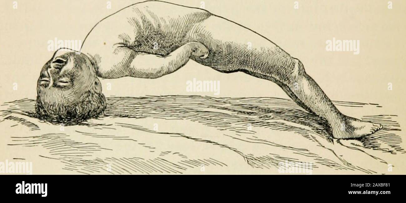 A treatise on the nervous diseases of children, for physicians and ...