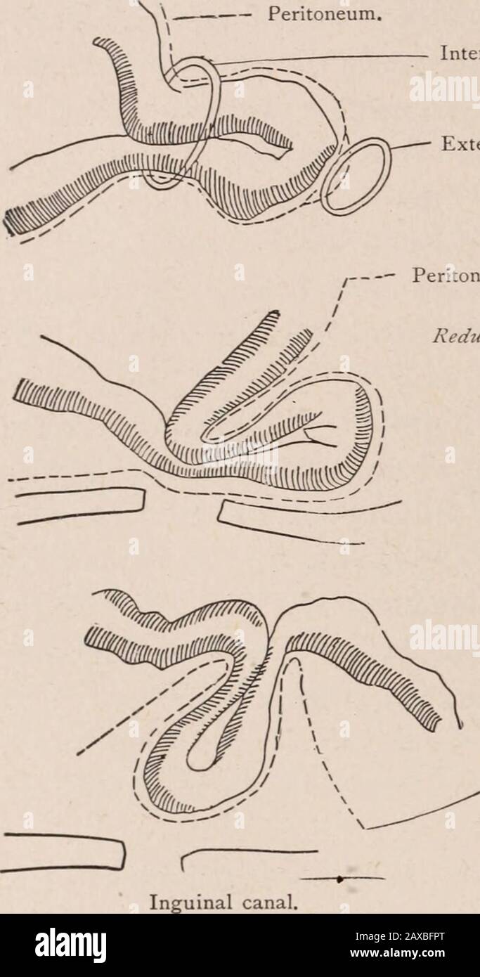 Buffalo medical and surgical journal . or the neck continues to be near the internal ring, while thefundus may deviate towards the navel, pelvis, or the iliac fossa.The parietal layer of the peritoneum must follow the neck of thesac so that it covers the whole sac like a funnel, when the neckis found torn loose and reduced high up. There is then a doublecover of peritoneum. Reduction en bloc is found both in smalland recent, and in old and large ruptures. Both inguinal andfemoral hernias may be reduced en bloc. 248 REDUCTION EN MASSE. The connective tissue around the sac seems to be stretchedm Stock Photo