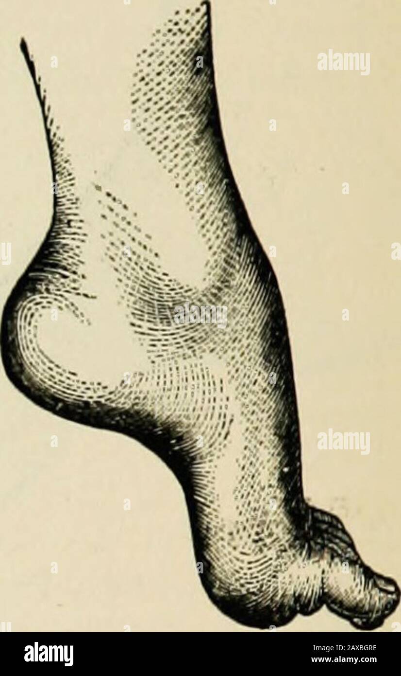 A treatise on the nervous diseases of children, for physicians and students . Fig. 26. — Pes Equinus in a BoyFive Years of Age from Atrophyof Tibialis Amicus.. Fig. 27.— Pes Equinus ofEight Years Duration. Tibialis AnticusExtensor Digit. Commun. Longus. Peroneus Brevis Extensor Hallucis Longus Dorsal Interossei Stock Photo