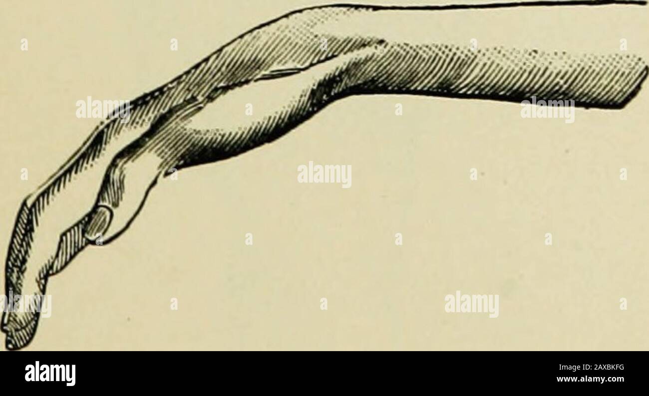 Flexor pollicis brevis Sehne