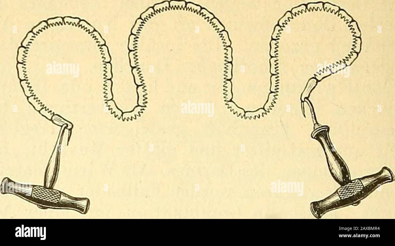 Therapeutisches Lexikon : für praktische Ärzte . Knochenzangen, sowie die sogenannten Be-sectionszangen (Fig. 6; Langenbeck) dienenzur Exerese des aus seinem Gefüge gelöstenKnochens. Die gewöhnlichen Instrumente zurBlutstillung, sowie blutigen Naht vervoll-ständigen das Instrumentarium. — Die Vo7-hereitungen zur Operation sind dieselben wiesie zur Amputation (s. d.) ausführlich geschil-dert wurden. Peinliche Sorgfalt in der Ein- haltung der antiseptischen Regeln ist bei derR., bei der bisweilen die Marklager derKnochen ausgiebig blossgelegt werden, daswesentliche Erforderniss des Erfolges. — W Stock Photo