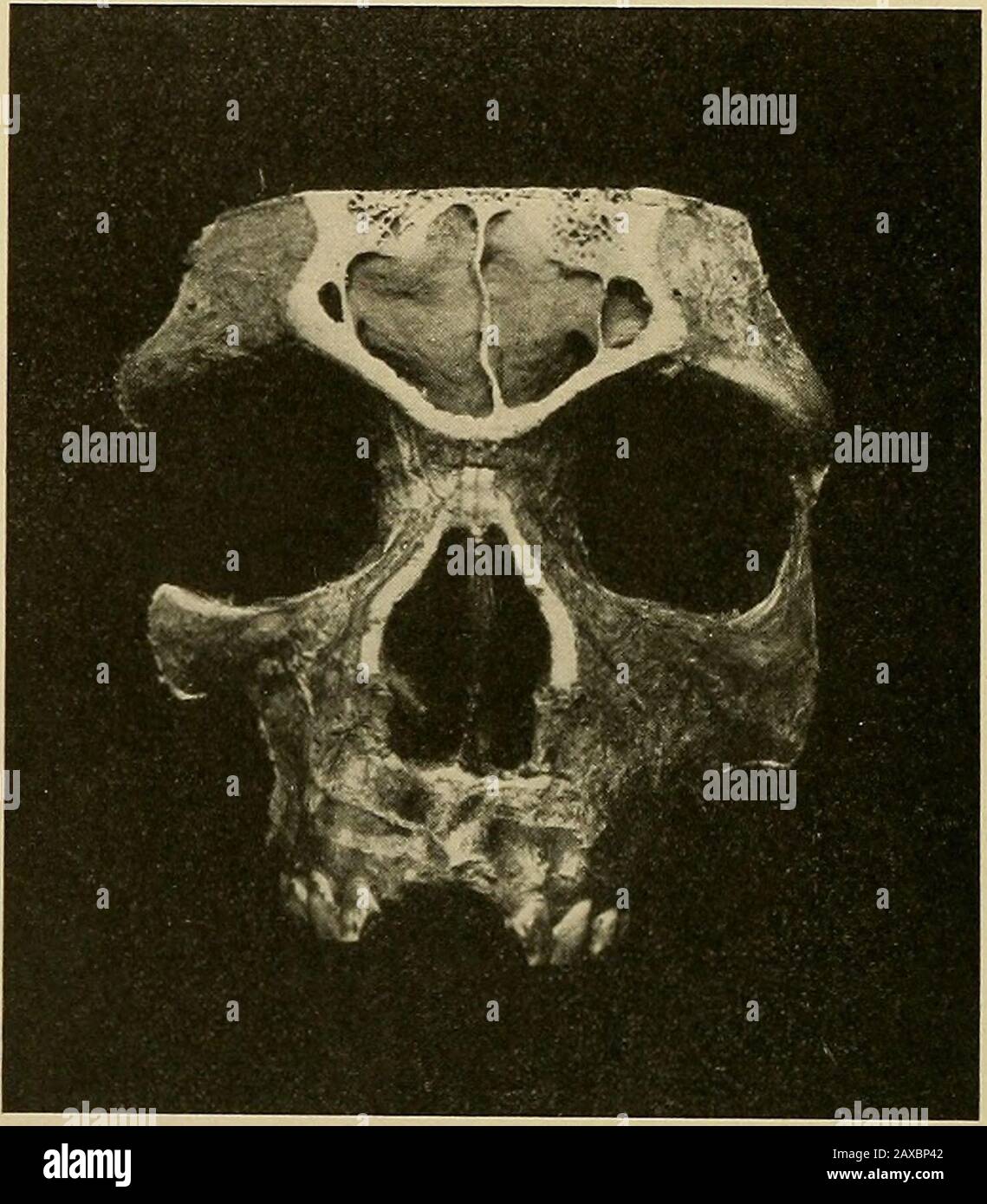 Applied anatomy and oral surgery for dental students . Fig. 11.—Anteroposterior division throuRh the maxillary sinus (Cryer). maxillary sinus from the nasal fossa. At the upper ante-rior portion of this wall is found an oval foramen—theostium maxillare—which affords communication betweenthe maxillary sinus andnniddle meatus, opening directlyinto the hiatus semilunaris. This is the only normal 42 APPLIED ANATOMY opening of the antrum of Highmore, but in certainpathologic conditions more than one opening may bepresent, when the normal opening becomes closed bypressure of the engorged mucous memb Stock Photo