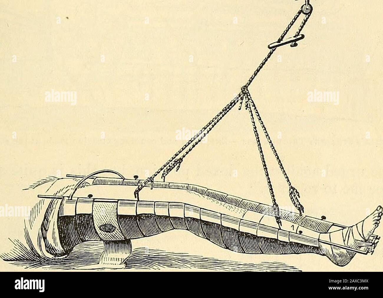 Smith Splint A practical treatise on fractures and dislocations . Palmers ...