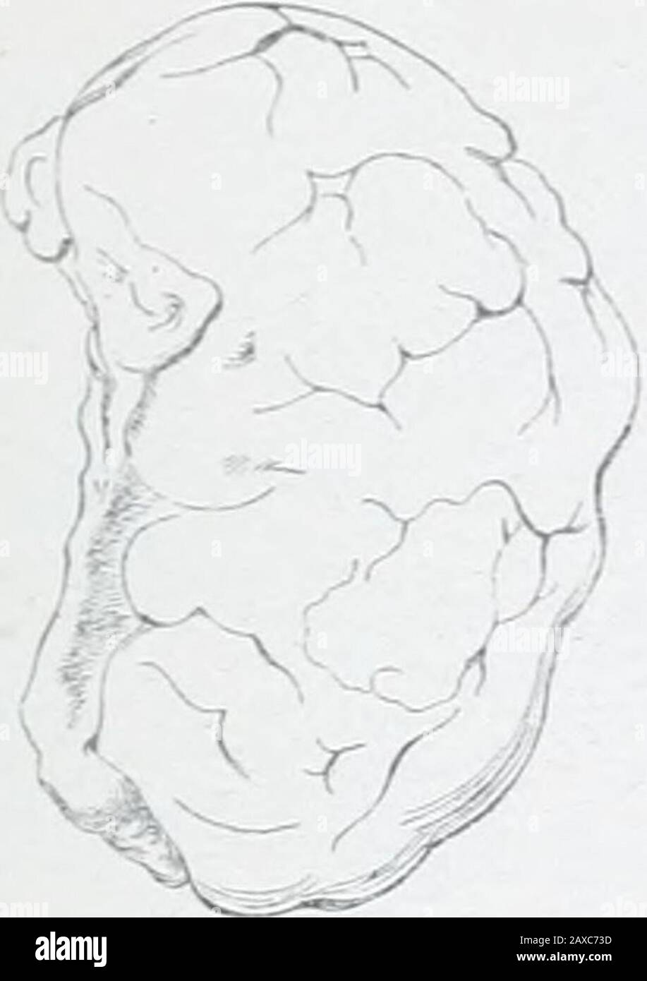 Birmingham Medical ReviewA quarterly journal of the medical sciences . lows:— There are no signs of alveolar degeneration; butthe elongated cells of the stroma are larger than innormal ovaries, and there are few vessels, the hypertrophx-of th(jse that remain, and the bundles of fibrous tissue,point to a cirrhotic change following the cxanthcmaticoophoritis. There were no morbid cysts, nor extravasationof blood ; no pathological breaking down. There weretwo Graafian vesicles, each about ixs of an inch indiameter, both close to the surface; the periphery of theovary being slightly denser than th Stock Photo