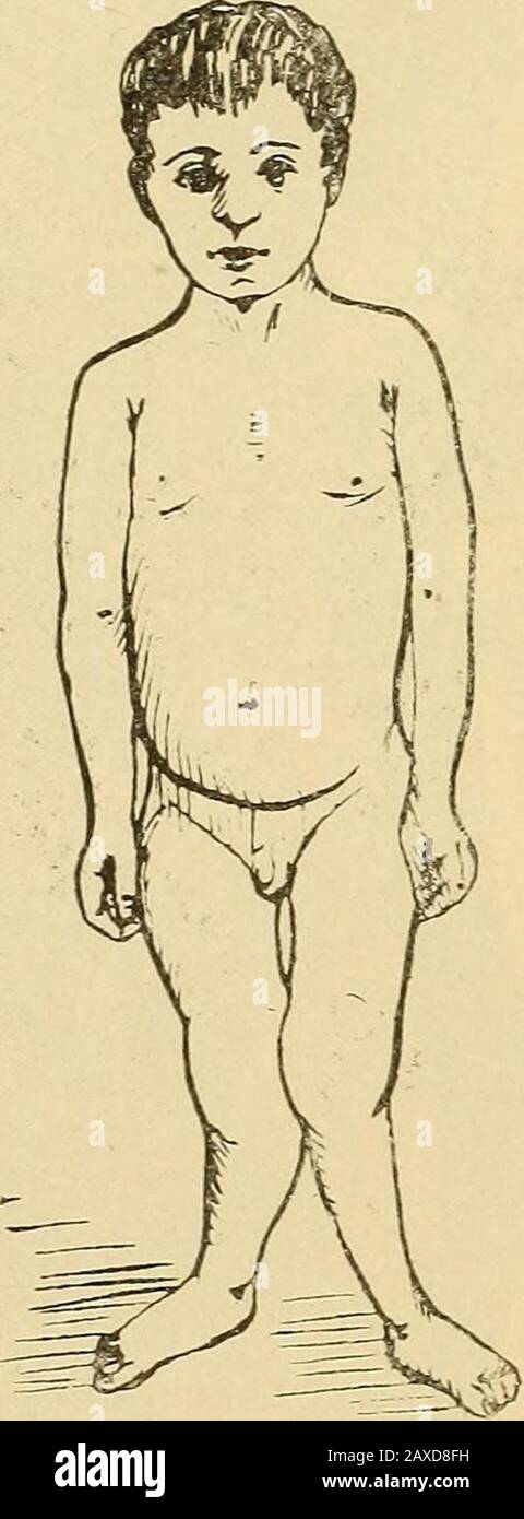 Lectures on orthopedic surgery . Fig. 214.—Knockknees and bowlegs in the same patient. 5. Back-lying, hands up,breathe deeply 10 to 20 times. 6. Back-lying, arms straight, the surgeon grasps thepatients hands, each alternately pulling and resisting,the arms make an excursion from the patients thighshorizontally to a point above his head, 10 times. 262 7. Back-lying, knee straight and stiff, foot extended,circle the legs, first one and then the other, 10 times. 8. Back-lying, knees held down, hands on hips, orstretched out, or locked at the back of the head, rise tothe sitting posture, 10 times Stock Photo