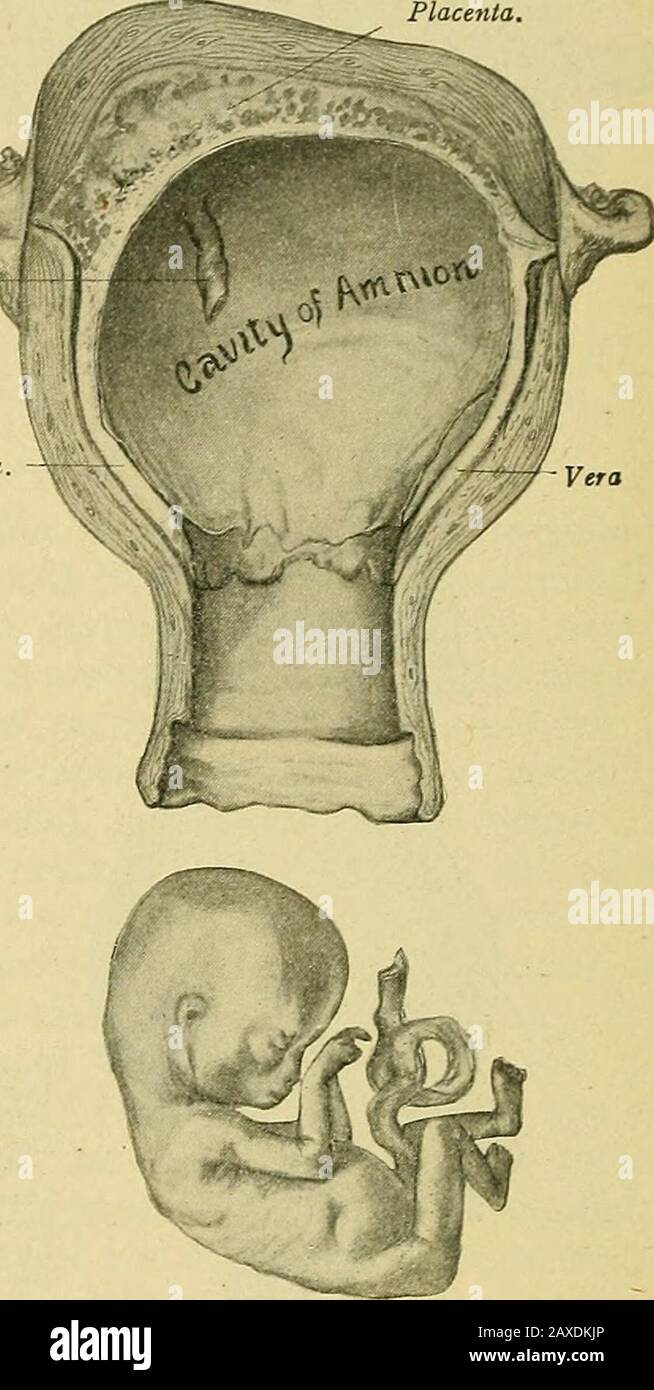 The practice of obstetrics, designed for the use of students and practitioners of medicine . Cord. ? V. I Amnion.Liguor amnii.Embryo, Fig. 476.—Third Type of Abortion.Retention of deciduse and chorion.Incomplete abortion.. Fig. 477.—Fourth Type of Abortion.Retention of deciduse, chorion, rudi-mentary placenta and amnion. In-complete abortion. ruptured by the descent of the ovum, leaving the former, with the vera and sero-tina, to pass away during the puerperium, or to be removed by operation. Again,we infrequently see the chorion as well as the reflexa ruptured, the cord beingtorn from the pla Stock Photo
