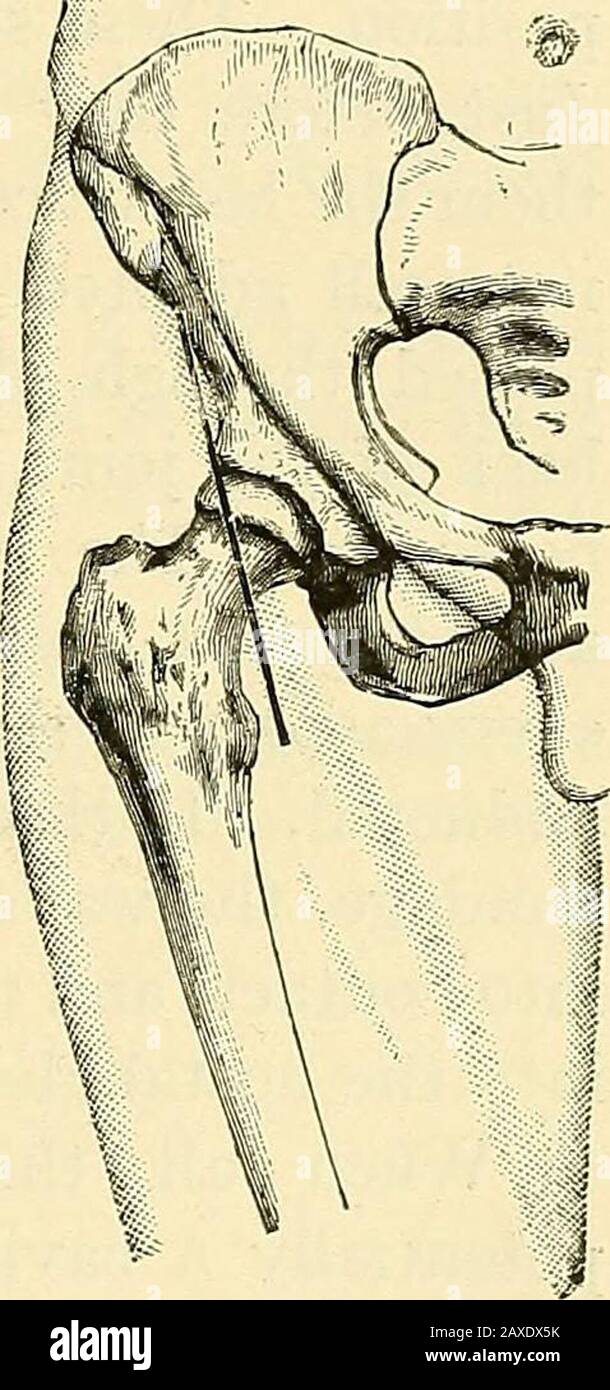 A manual of operative surgery . ius and rectus on the inside,until it reaches the neck of the femur.This incision does not divide any musclefibres or vessels or nerves of the slightestimportance. It is unnecessary to carrythe deeper part of the incision to thefull extent of the external wound. If anabscess is opened up before the jointis reached, its contents are thoroughlyflushed out with sterilised hot water, at a temperature of between 1050 and no0, before anythingfurther is done. Mr. Barkers well-known flushing-gouge may beused for the purpose—though an ordinary strong Volkmannsscoop will Stock Photo