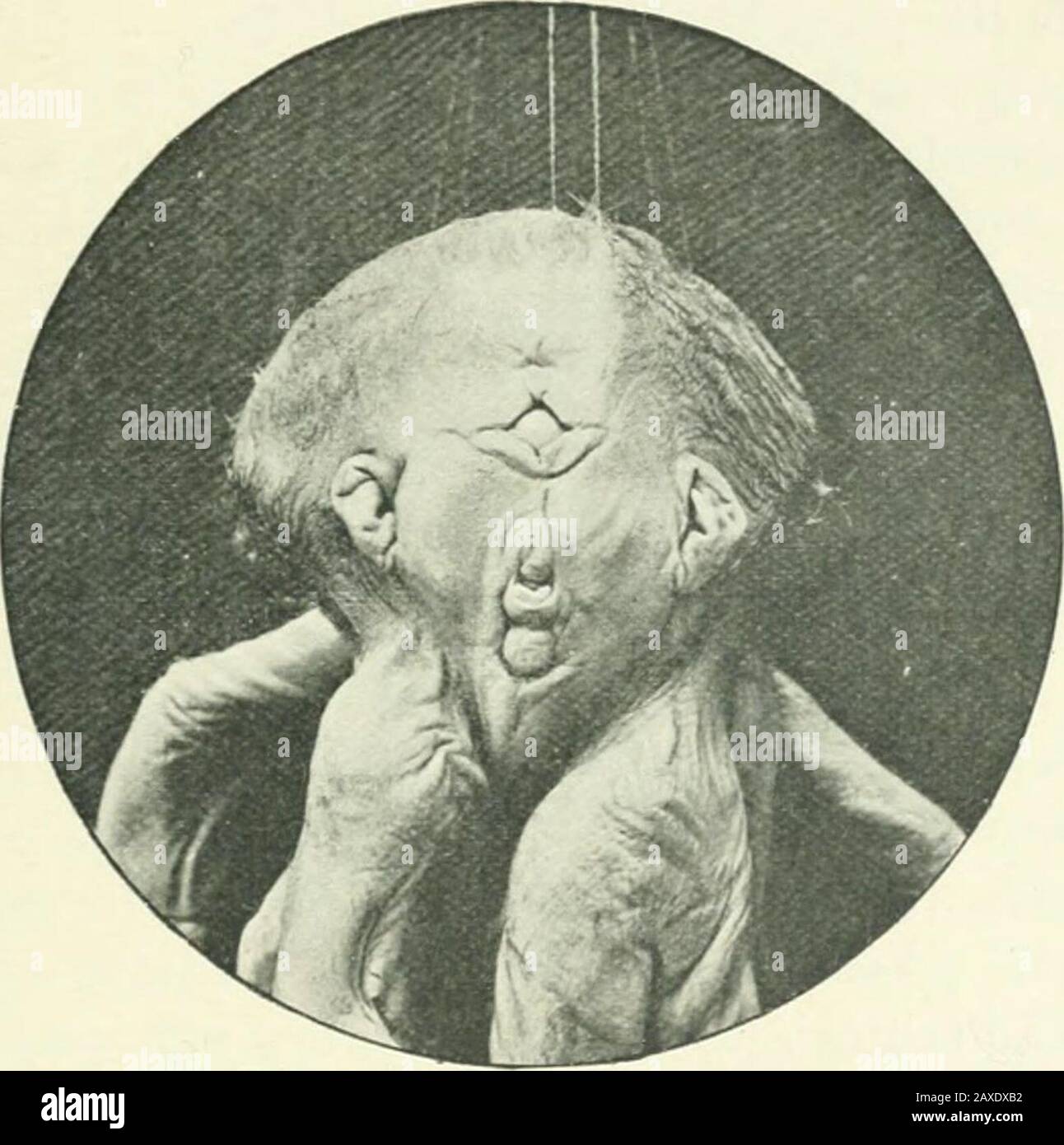Transactions . globe, but there were two quite separateoptic discs  separated by a process of mesoblast. Twopersistent hyaloid arteries were  present. Specimen No. 4. Human cyclops (twin). This specimen represents an  extremely