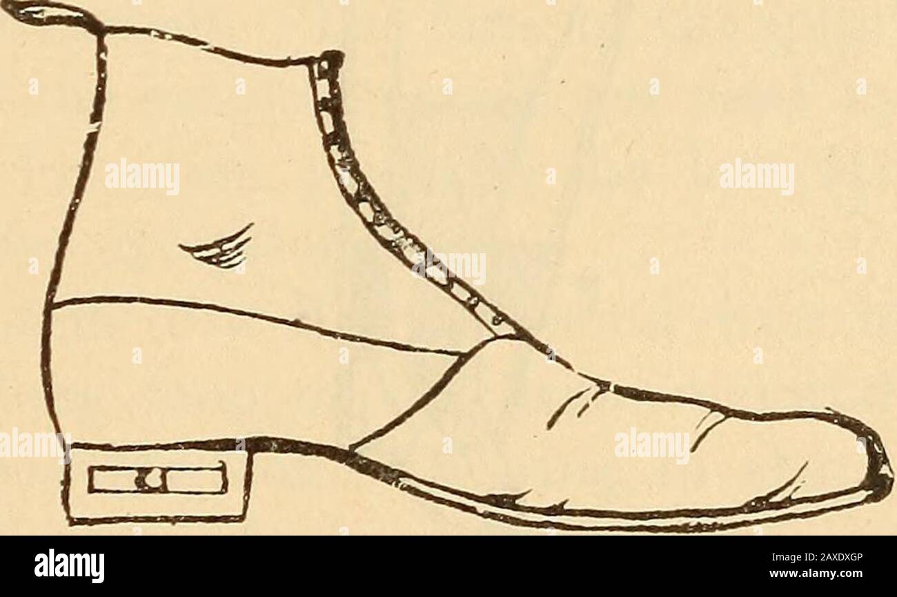 Caliper splints hires stock photography and images Alamy