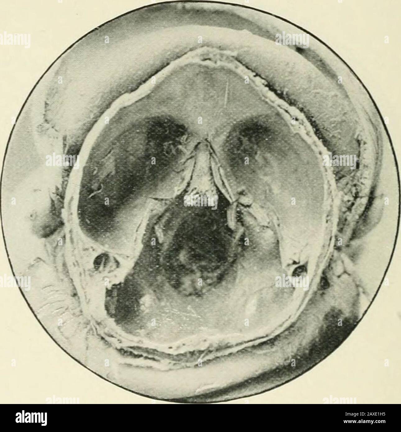 Transactions . Specimen No. 2. A human cyclops showing the absence of a  proboscis, notching of the upper lids. was complete absence of any proboscis,  a condition which,so Ear as I know,