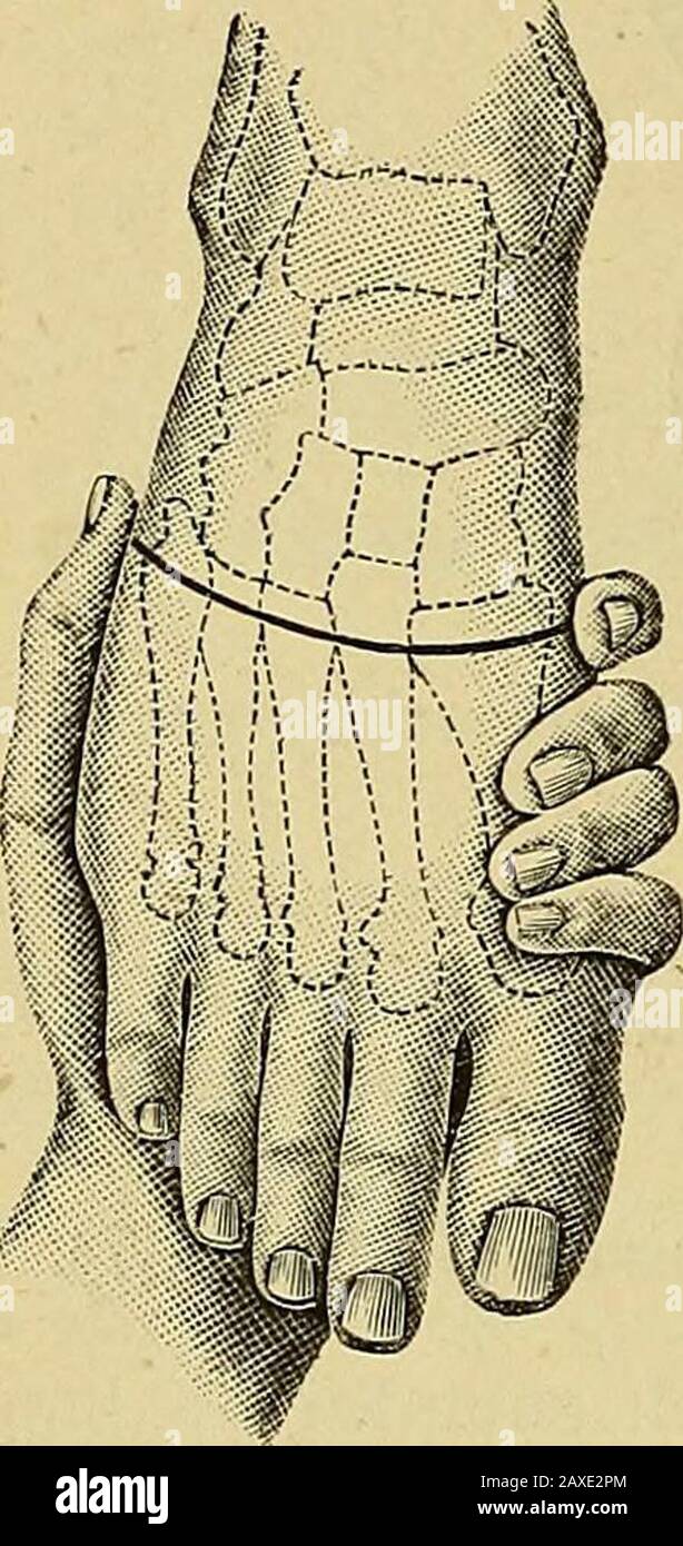 The surgeon's handbook on the treatment of wounded in war : a prize essay . Disarticulation at the tarso - metatarsal joints (LISFRANC). Esmareh, the Surgeons Handbook. 14 20 Fig. 368. Fig. 369.. Stock Photo