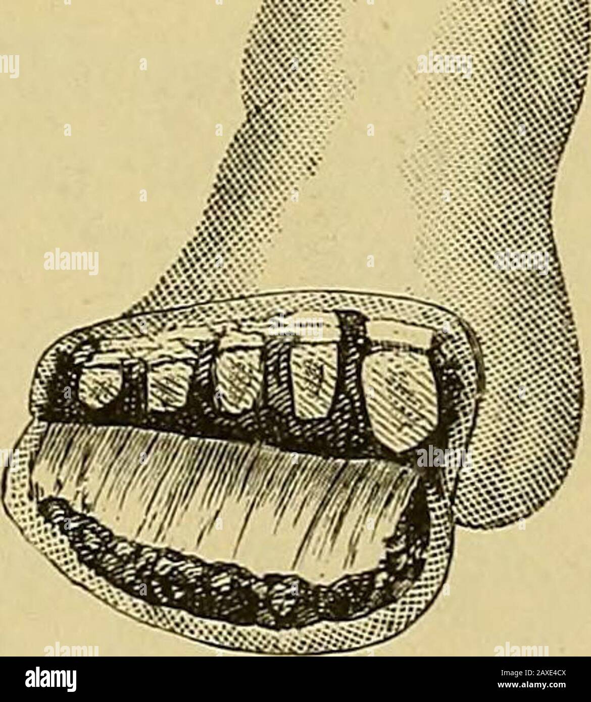The surgeon's handbook on the treatment of wounded in war : a prize essay . Appearance of the wound after sawing throughthe metatarsal bones. Amputation of the foot through the metatarsalbones (sawing). d. Disarticulation of the big toe with its metatarsal bone. 1. The oval incision is performed in the same manner as hasbeen described in the disarticulation of the thumb (pag. 193). On account 208 Stock Photo