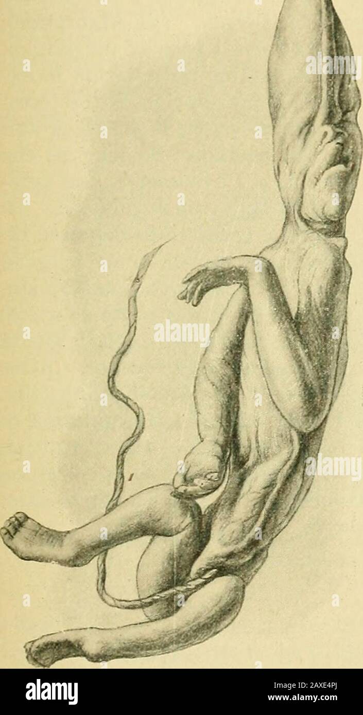 Fetus within an uterus hires stock photography and images Alamy