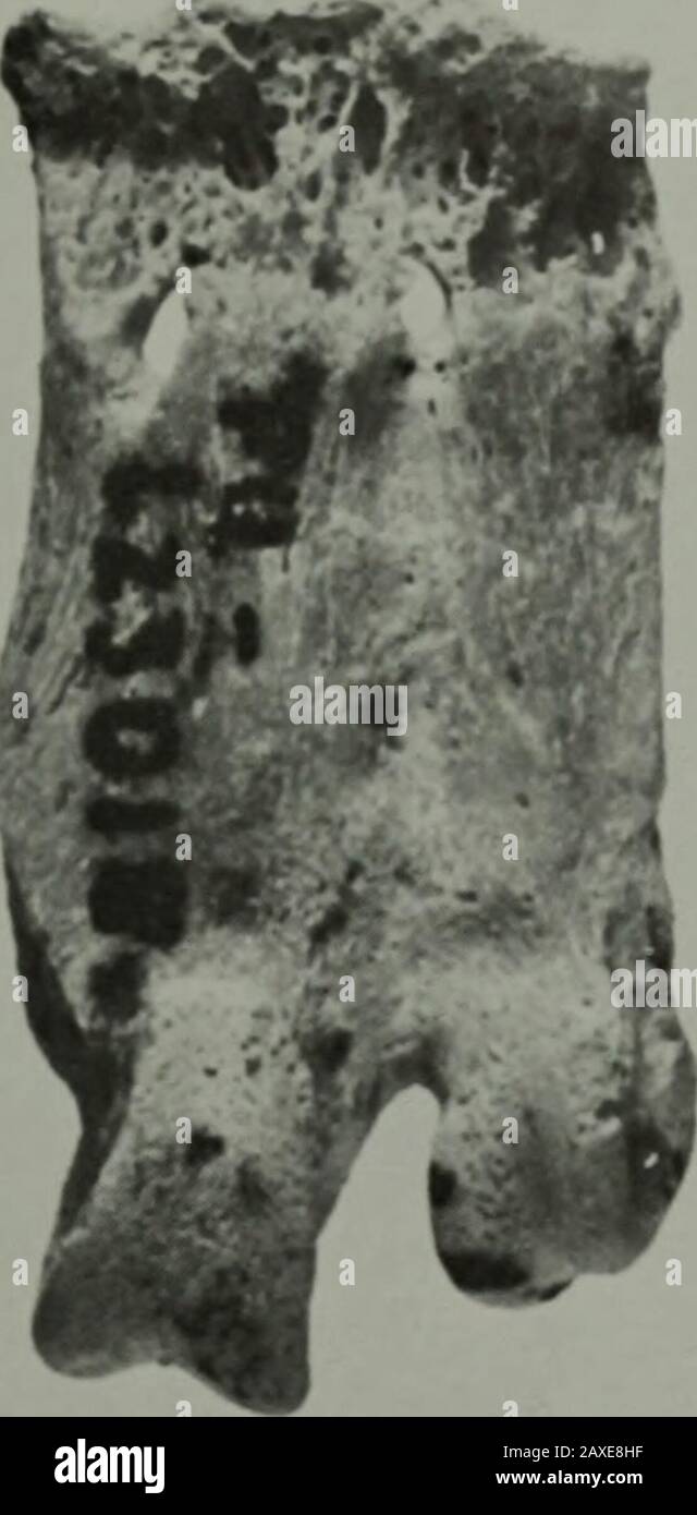 Medial calcaneal hi-res stock photography and images - Alamy