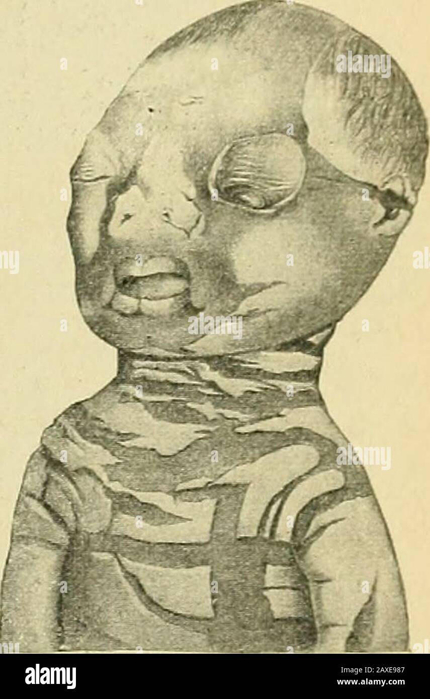 The practice of obstetrics, designed for the use of students and practitioners of medicine . e skin, evident at birth, ashappens in the case of other organs. When the lack is total {e. g., atrichia), itis apt to be accompanied by other deformities. More or less localized aberrantgrowth is shown in the formation of naevi of various sorts—vascular, pilary, pig-mented, papillomatous, verrucous. Aside from these tumors, the commonestmisdirection of the great embryonic cellular activity is in an increase of thesurface layers of the epidermis, the stratum corneum particularly, which is calledichthyo Stock Photo