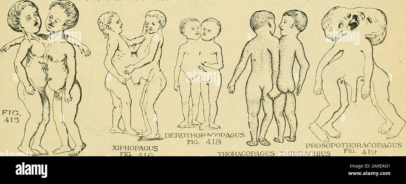 The practice of obstetrics, designed for the use of students and practitioners of medicine . MONOCEPHALUS DIBRACHIUS DIPUS FIG 412   MONOCEPHALUS DIBRACHIUS TETRAPUSM0N0CEPHALU5 DIBRACHIUS TRIPUSFIG. 414 FIG. 413 5. AMPHISCHISTOI (cloven above and BELOW). 3TERNOPAGUS ^DEROTHOPAf-npAGUS XIPHOPAGUS ^^ ^^ ^^  PROSOPOTHORACOPAGUS FTG. 4.1P, THOR.COPAGUS TRIBRAClilUS ^^- 4-^ FIG. 417 253 Stock Photo