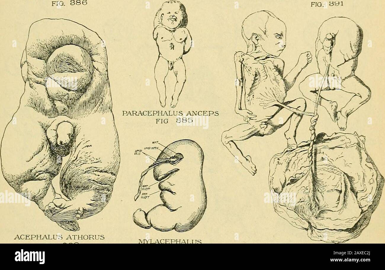 The practice of obstetrics, designed for the use of students and practitioners of medicine . AMORPHUS ANIDEUS no. yyi. ACEPHALUS ATHORUSFIG. 889 MYLACEPHALUSFIG 890 ACEPHALUS THORUSFIG. 888 Etymological Key.—Prefixes: a- or an-, absence of; syn- or sym-, fusion, orblending of two symmetrical structures; mono^, single, undivided; di-, two; tri-,three; anti-, opposed or opposite; i^ira-, four; epi-, above; hypo-, below;ectro-, abortive, defective, rudimentary; 5c/jz5to-, cleft; micro-, small; hemi-,half. Suffixes: -pagM5, united, connected;-sc/iV5i05, cleft. Parts ofBody-cephalus, head; -cormus, Stock Photo
