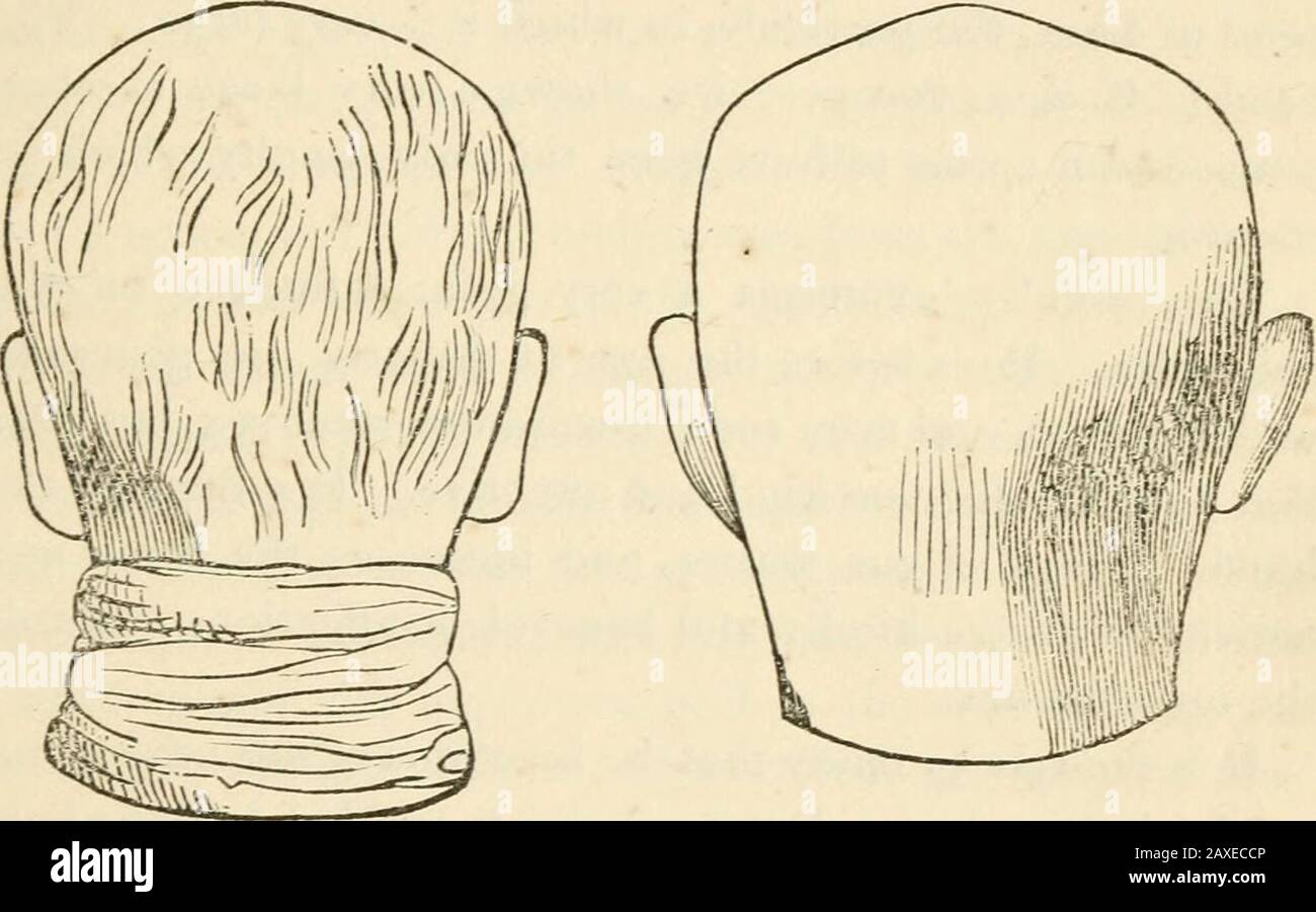 Lectures on phrenology, including its application to the present and prospective condition of the United States . ess. To learn the situation of this organ, feel on the middleline toward the base of the skull at the back part of thehead, and you will iind a small bony projection named theoccipital spine. Amativeness is situated below that pointand between the mastoid processes. The size of the organis indited by the extension of the inferior surface of the AMAT1VEXFSS. 137 nccipi.al bone backward and downward, or by the thick-ness of the neck at these parts between the ears. Its largesize give Stock Photo
