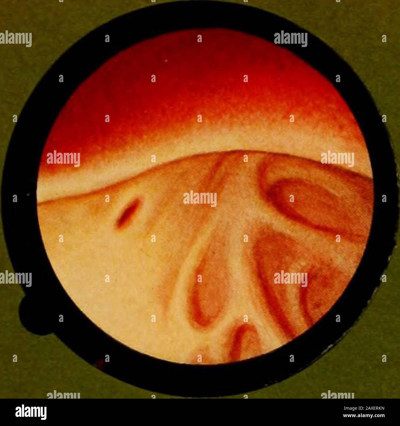 Traitâe pratique de cystoscopie et de cathâetâerisme urâetâeral . cidely convex. but with stillperceevable meatus. Same aspect with visible meatus. Blood suffusion on a prostatic prominence. Prostatic prominence seen in a retrograd cystoscope. STAMPA XXXII. FlG. 1 Fig. 2 Fig. 3 Fig. 4. Fig. 5 Primo grado ilipertrofia prostatica, che lascia vedere loriflcio ureterale. Grado più accentuato dell ipertrofia, gia francamente convessa; ma tuttavia sipué ancora scorgere il meato. Il medesimo aspetto, con meato visibile. Sufïusione sanguigna sopra una sporgenza prostatica. Sporgenza prostatica veduta Stock Photo