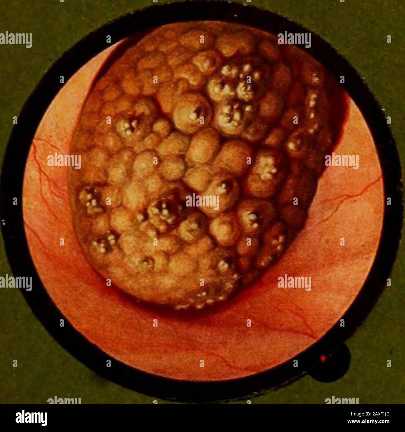 Traitâe pratique de cystoscopie et de cathâetâerisme urâetâeral . Fig. l2. Stock Photo